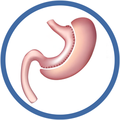 Sleev-Gastrectomy